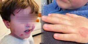 Kreşe giden 2,5 yaşındaki çocuk darp edildi